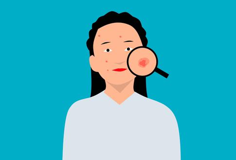 6 главных ошибок в лечении акне