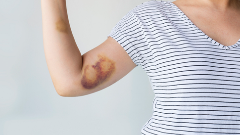 Синяки без причины: почему появляются гематомы и как их убрать