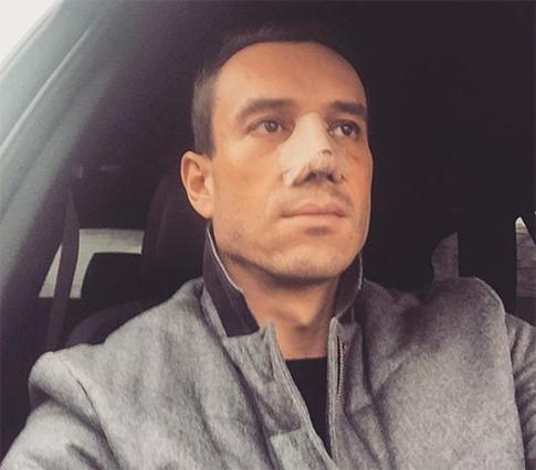 Михаил Терехин сделал пластику носа